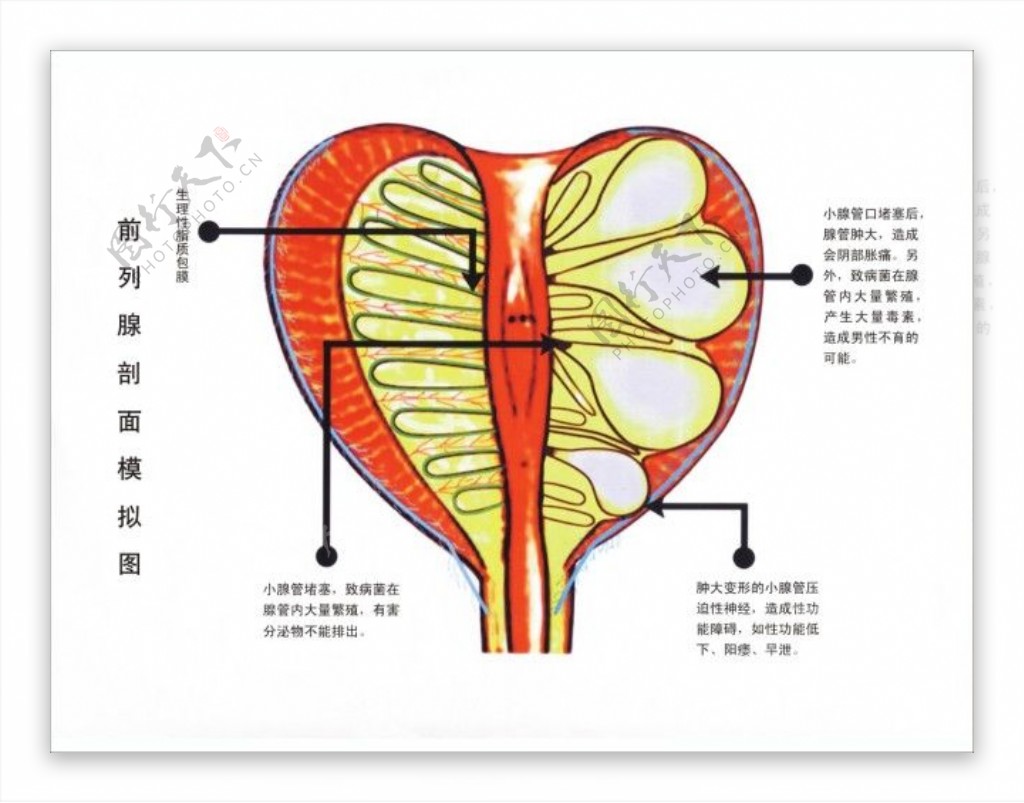 医院展板男科女前列腺剖面模拟图