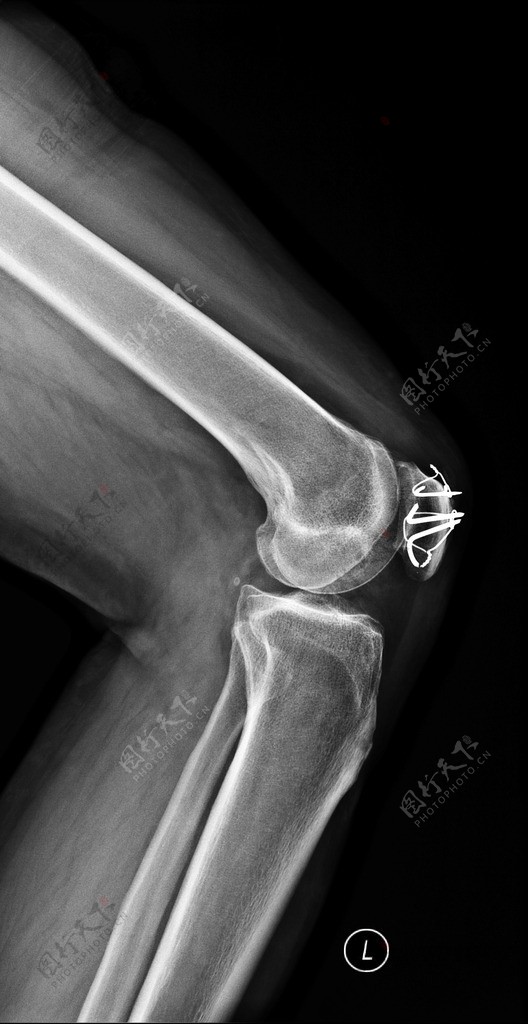 X线照片膝关节图片