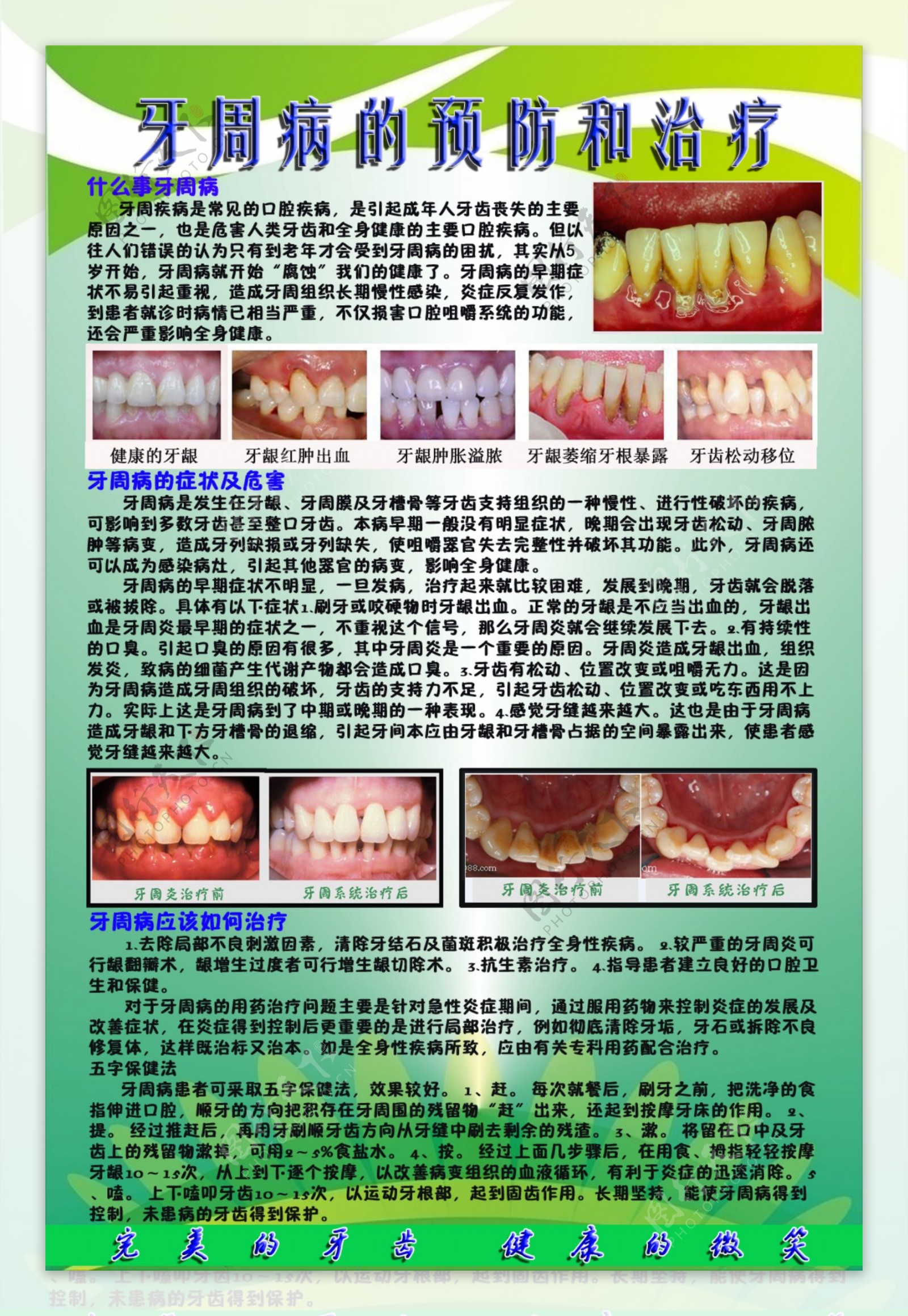 牙周病 | 牙周病症狀及治療方法 | 卓健醫療