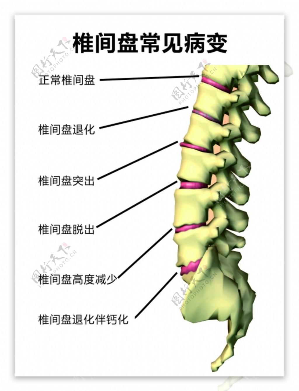 腰椎间盘常见病变