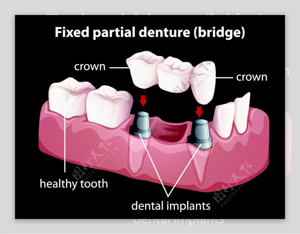 牙齿治疗图案设计图片