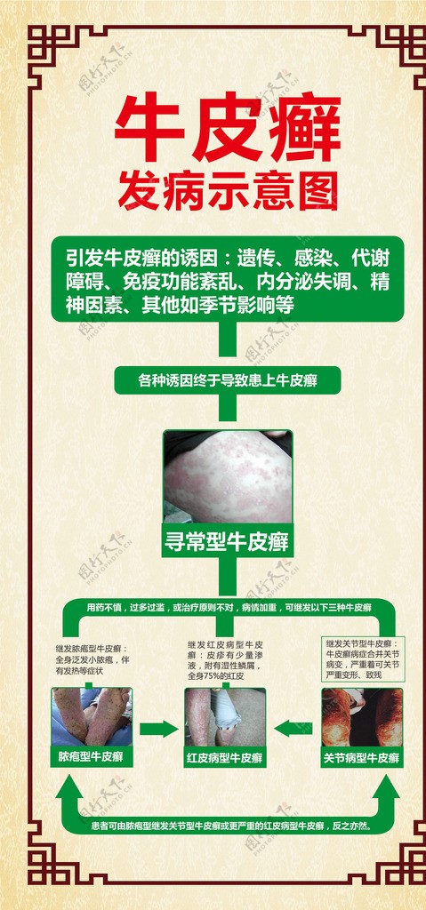 牛皮癣发病示意图