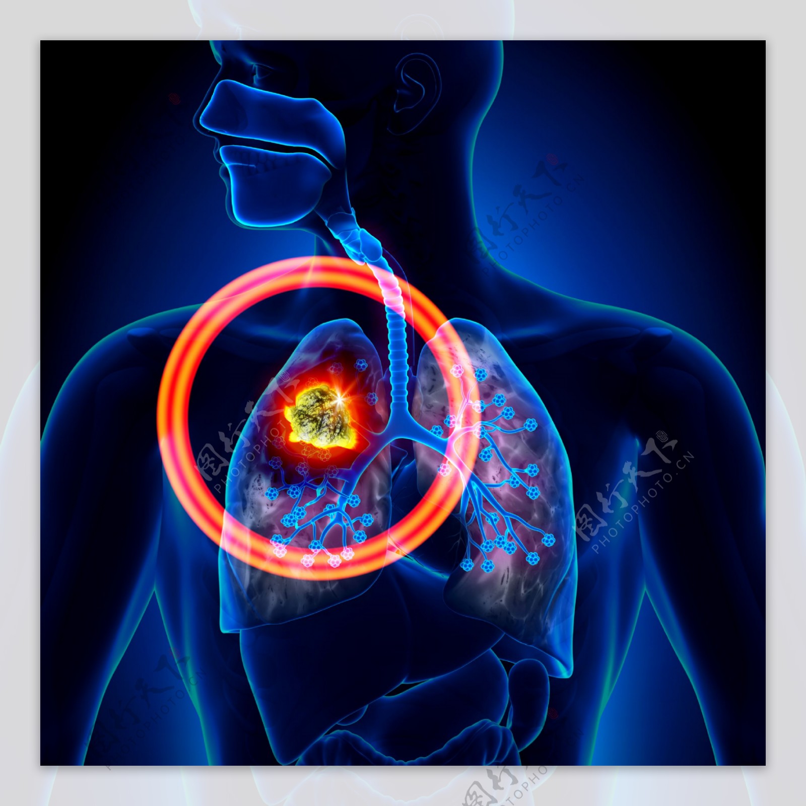 肺癌信号图片