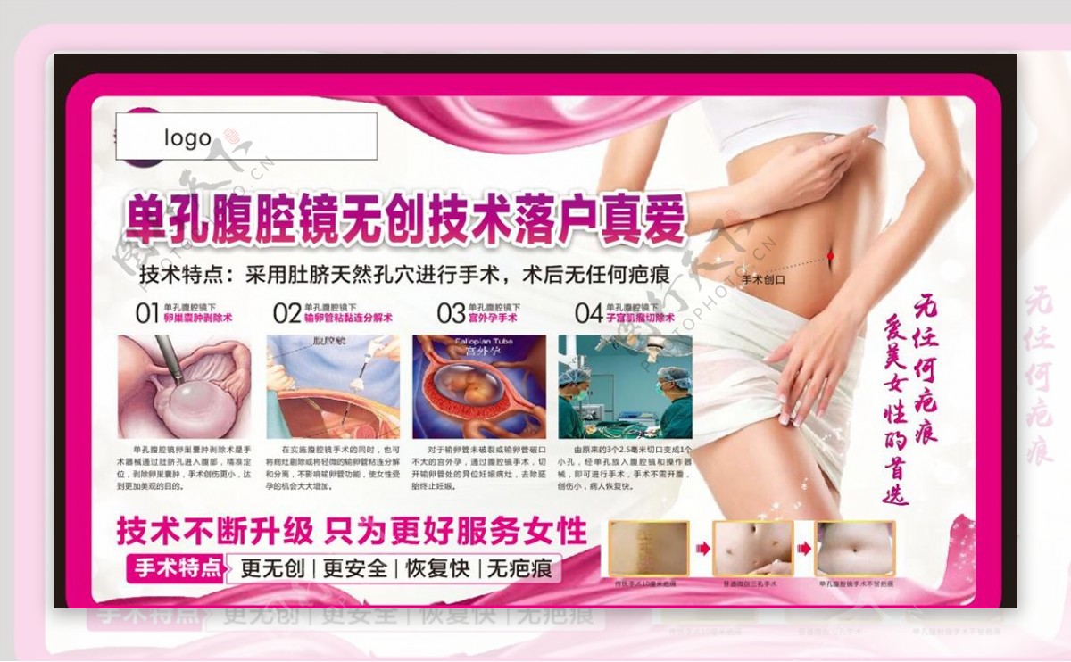 单孔腹腔镜妇科广告