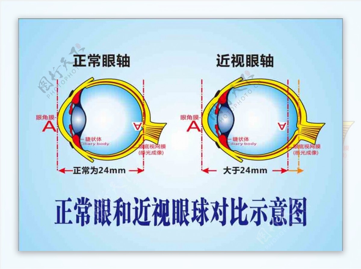 正常眼和近视眼球对比示意图