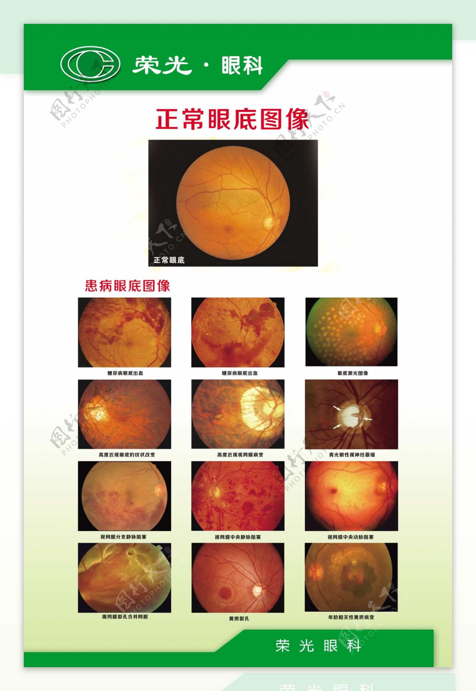 常见眼底病变