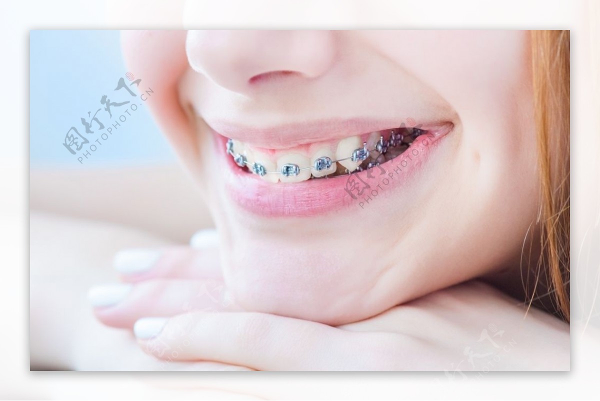 【地包天箍牙】21歲男生箍牙案例分享_康复案例